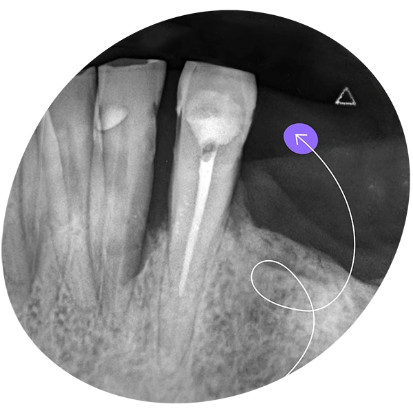 Endodoncia