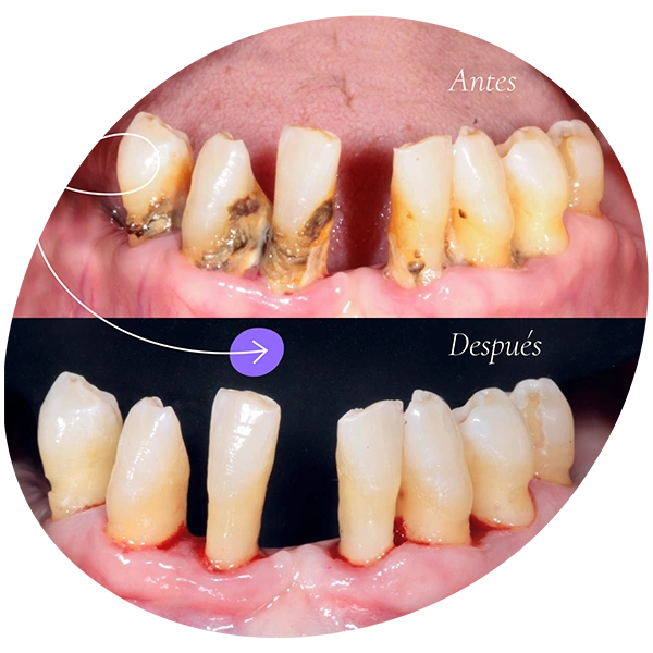 Periodoncia, antes y después.